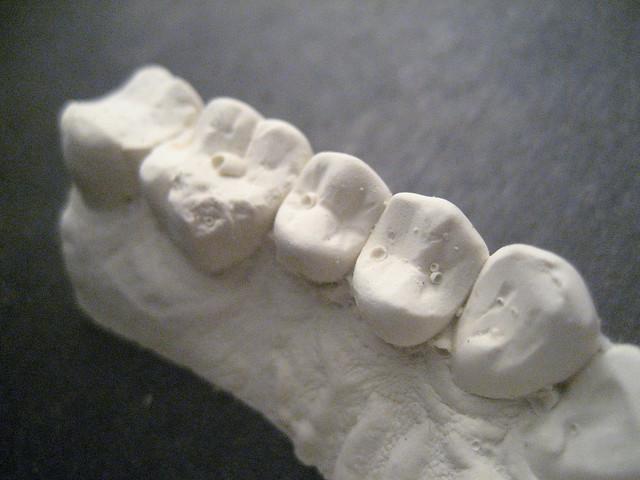 Cast of upper teeth July 2011