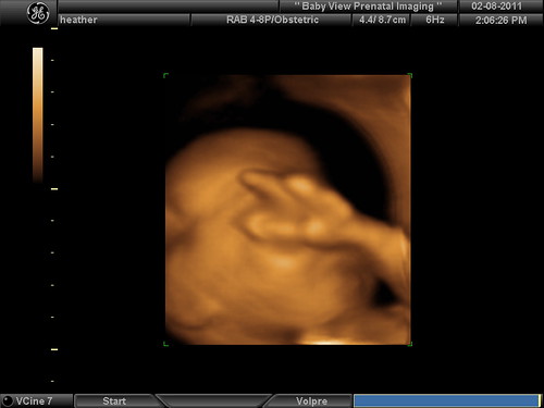 3D Ultrasound: No more photos!
