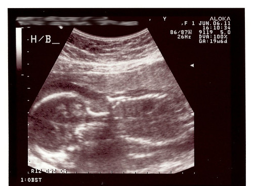 ultrasoundsC1