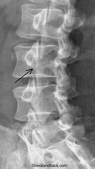 Pars Fracture of the Spine | Spondylolysis | O...