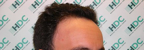 Bild framifrån by Hairtransplant