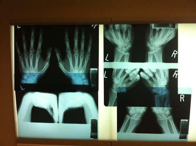 Hand x-rays