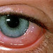 allergy-eyes1