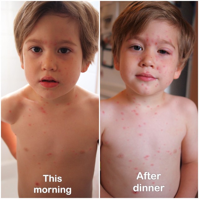 Chicken Pox Pictures Early Stages | HRFnd