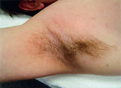 Laser Hair Removal Side Effects:Ingrown Hair - Seven Causes & Eight Effects