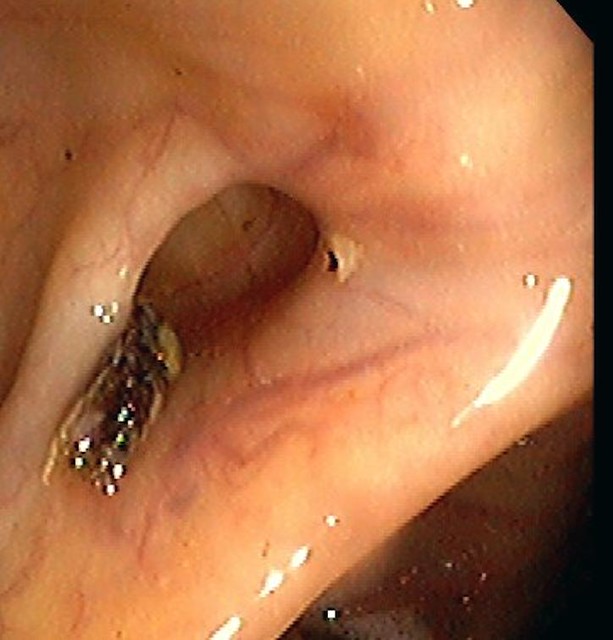 DIVERTICULOSIS WITH CLOT (SOURCE OF BLEEDING)