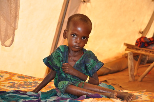 A malnourished child in an MSF treatment tent in Dolo Ado