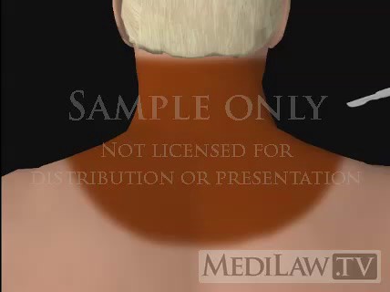 Cervical Spine Lateral Mass Screw Fusion Fixation courtroom 3D animations