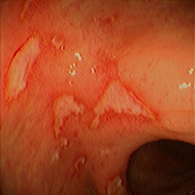 Crohn's Ulcers of the Colon