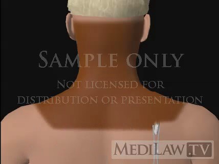 Cervical Spine Laminectomy medico-legal multimedia