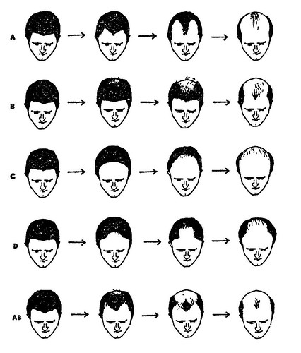black and white visual description of male pattern balding and hair loss