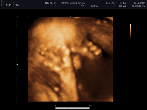 Iris Adella 3D Ultrasound