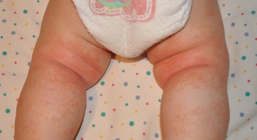 rashes on babies legs #10