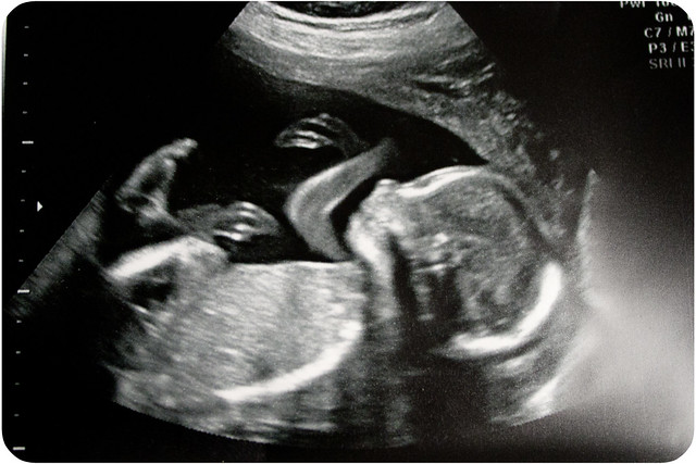 Baby boy #2, 20 week ultrasound