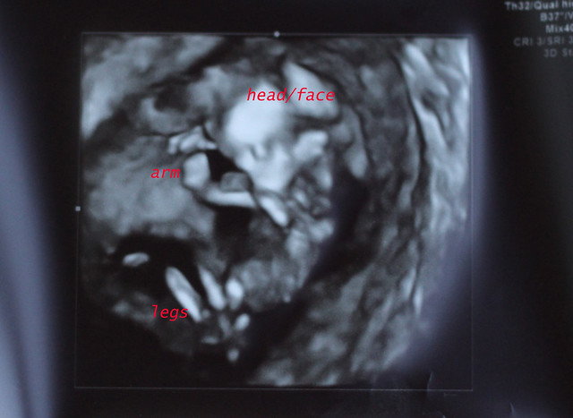 ultrasound13weeks2