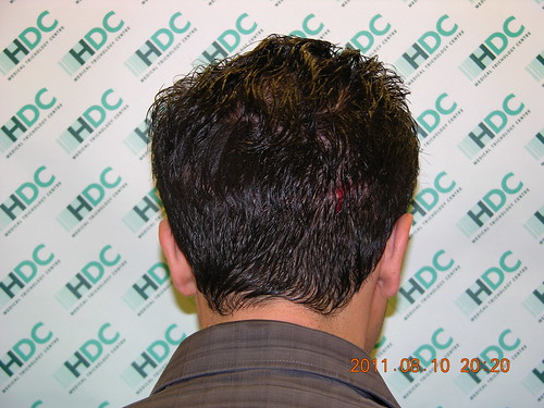 Bild bakifrån by Hairtransplant