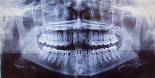 June 2011 Panoramic X Ray by Jay Medeiros