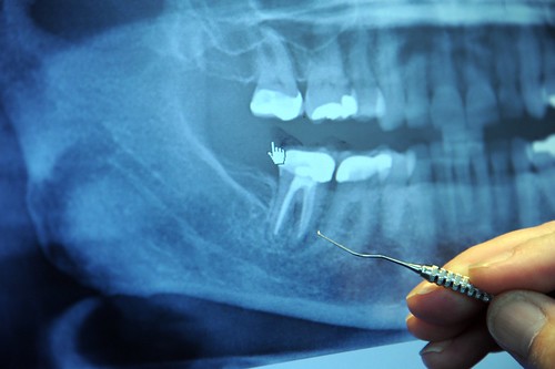 Dr. Alan Carr points out the broken root of a right rear molar (tooth), dental tool, orthodontist's office, full jaw Xray, Factoria, Washington, USA by Wonderlane